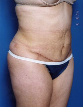 Woman's body, after Tummy Tuck treatment, r-side oblique view, patient 14