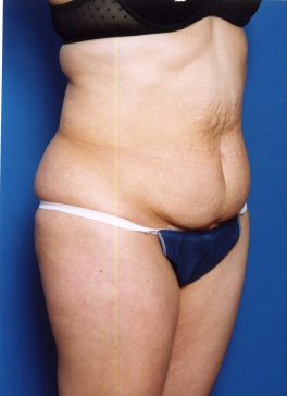 Woman's body, before Tummy Tuck treatment, r-side oblique view, patient 14