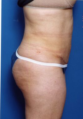 Woman's body, after Tummy Tuck treatment, r-side view, patient 14