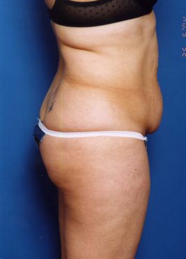 Woman's body, before Tummy Tuck treatment, r-side view, patient 14