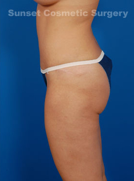 Woman's body, after Tummy Tuck treatment, l-side oblique, patient 2