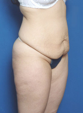 Woman's body, before Tummy Tuck treatment, r-side oblique view, patient 2