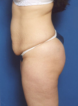 Woman's body, before Tummy Tuck treatment, l-side oblique, patient 2