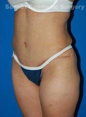 Woman's body, after Tummy Tuck treatment, l-side oblique view, patient 3