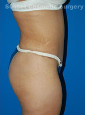Woman's body, after Tummy Tuck treatment, r-side view, patient 3
