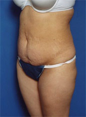 Woman's body, before Tummy Tuck treatment, l-side oblique view, patient 3