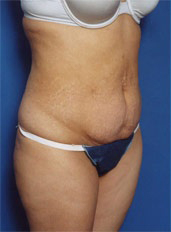 Woman's body, before Tummy Tuck treatment, r-side oblique view, patient 3