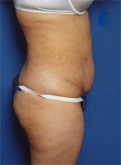 Woman's body, before Tummy Tuck treatment, r-side view, patient 3