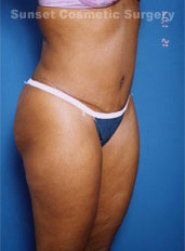 Woman's body, after Tummy Tuck treatment, r-side oblique view, patient 4