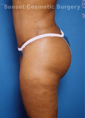 Woman's body, after Tummy Tuck treatment, l-side view, patient 4