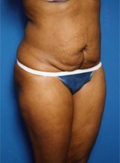 Woman's body, before Tummy Tuck treatment, r-side oblique view, patient 4