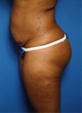 Woman's body, before Tummy Tuck treatment, l-side view, patient 4