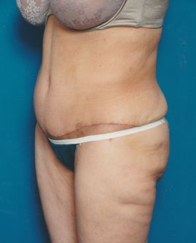 Woman's body, after Tummy Tuck treatment, l-side oblique view, patient 5