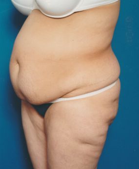 Woman's body, before Tummy Tuck treatment, l-side oblique view, patient 5