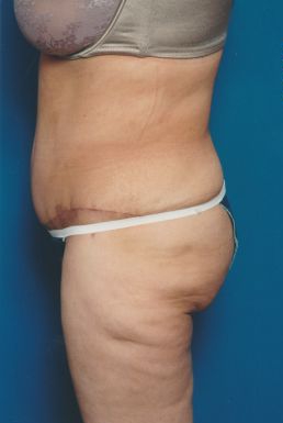 Woman's body, after Tummy Tuck treatment, l-side view, patient 5