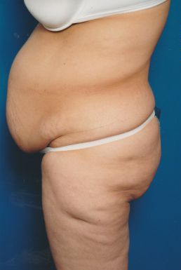 Woman's body, before Tummy Tuck treatment, l-side view, patient 5