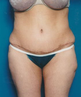 Woman's body, after Tummy Tuck treatment, front view, patient 5