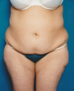 Woman's body, before Tummy Tuck treatment, front view, patient 5