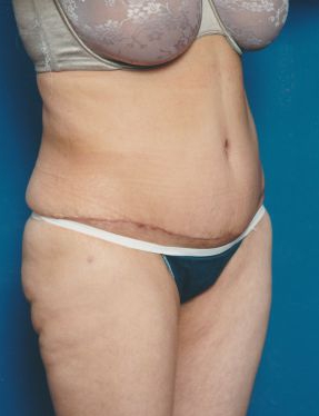 Woman's body, after Tummy Tuck treatment, r-side oblique view, patient 5
