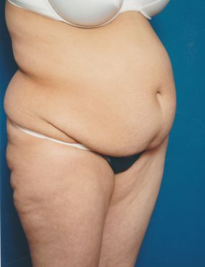 Woman's body, before Tummy Tuck treatment, r-side oblique view, patient 5