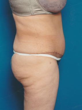 Woman's body, after Tummy Tuck treatment, r-side view, patient 5