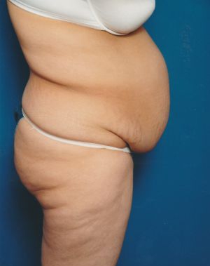 Woman's body, before Tummy Tuck treatment, r-side view, patient 5