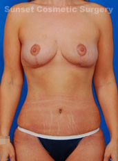 Woman's body, after Tummy Tuck treatment, front view, patient 6