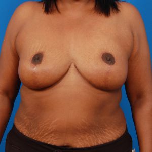 Woman's body, after Breast Reduction treatment, front view, patient 8