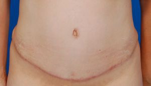 Woman's body, after Tummy Tuck treatment, front view, patient 9