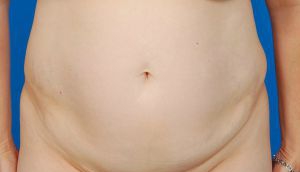 Woman's body, before Tummy Tuck treatment, front view, patient 9