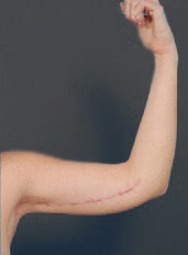 Woman's hand, after Arm Lift treatment, front view (l-hand), patient 2