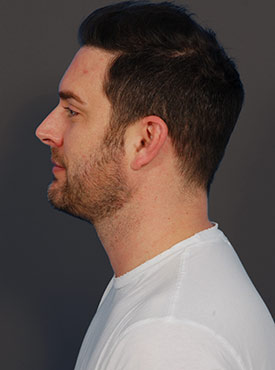 Male face, after Submental Lipocontouring, l-side view, patient 1