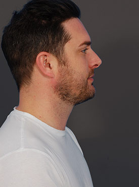 Male face, after Submental Lipocontouring, r-side view, patient 1