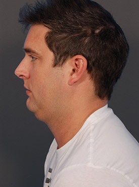 Male face, before Submental Lipocontouring, l-side view, patient 1