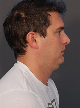 Male face, before Submental Lipocontouring, r-side view, patient 1