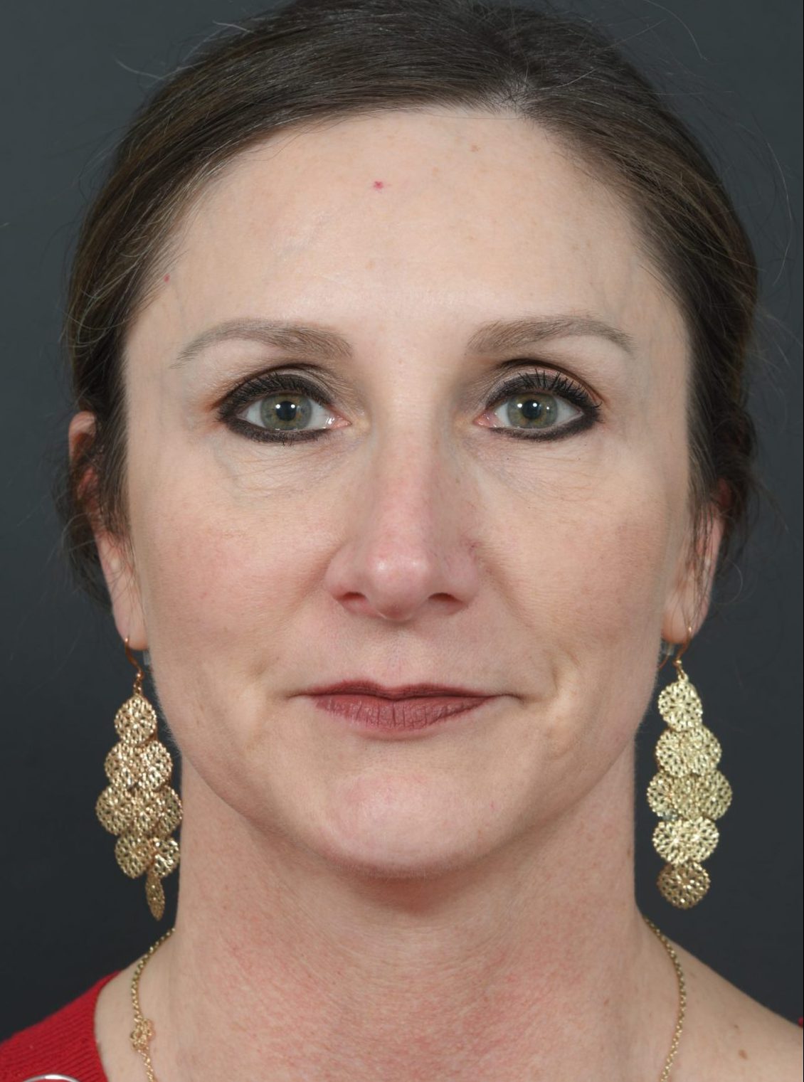 Female face, after Botox treatment Case 2 Front Before Los Angeles