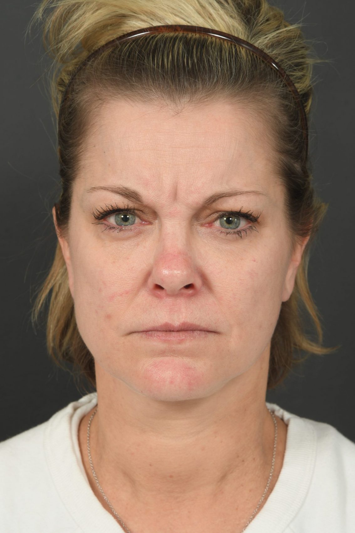 Female face, before - Botox treatment, front view, patient 1