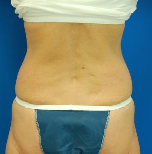 Female body, before Liposuction Revision treatment, back side view, patient 1
