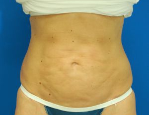 Female body, before Liposuction Revision treatment, front view, patient 1