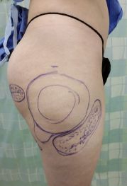 Female body, before Liposuction Revision treatment, r-side view, patient 3