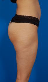 Female body, before - Liposuction Revision treatment, r-side view, patient 3