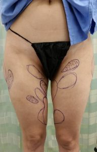 Female body, after Liposuction Revision treatment, front view, patient 3