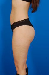 Female body, - after Liposuction Revision treatment, l-side view, patient 3