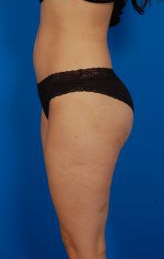 Female body, before Liposuction Revision treatment, l-side view, patient 3