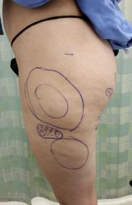 Female body, after Liposuction Revision treatment, l-side view, patient 3