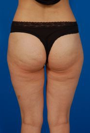 Female body, before - Liposuction Revision treatment, back side view, patient 3