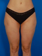 Female body, before Liposuction Revision treatment, front view, patient 3