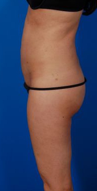 Female body, after Revision Liposuction treatment, l-side view, patient 4