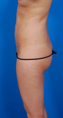 Female body, before Revision Liposuction treatment, l-side view, patient 4