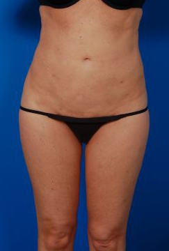 Female body, before Revision Liposuction treatment, front view, patient 4